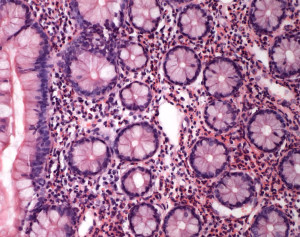Eosinophilic gastroenteritis. Photo By  [CC-BY-2.0 (http://creativecommons.org/licenses/by/2.0)], via Wikimedia Commons